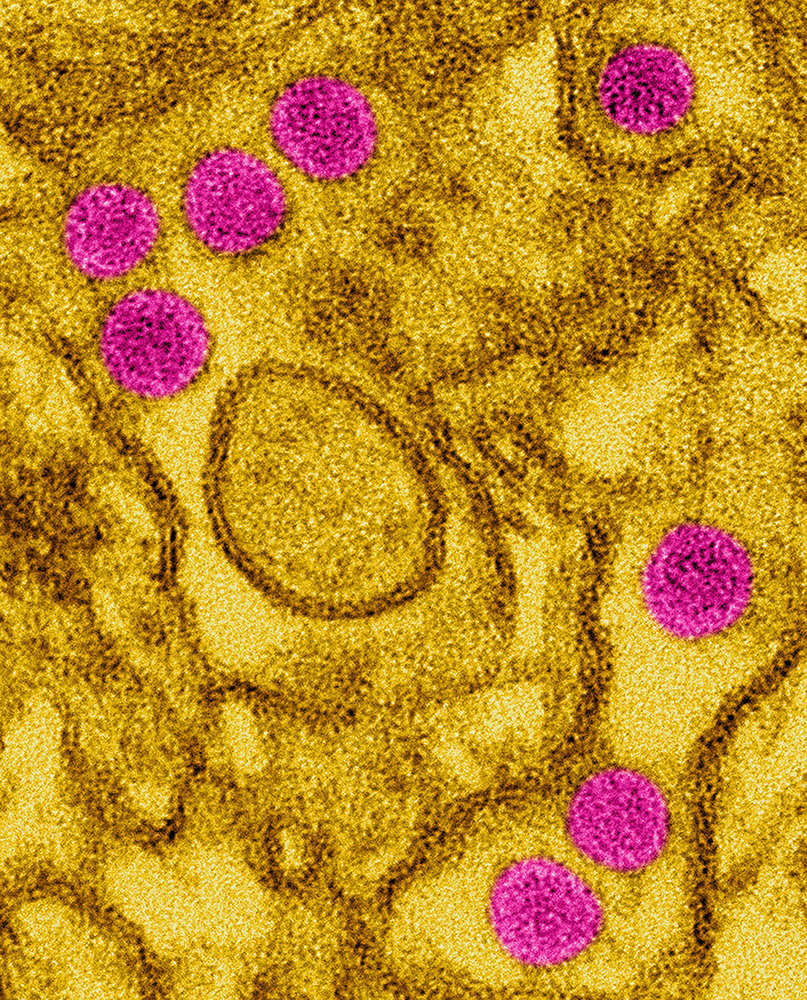 Coloured transmission electron micrograph of Zika virus particles (pink) isolated in kidney epithelial cells (Vero E6 cells). Aedes aegypti mosquitoes can transmit Zika virus to humans. In addition, the virus can be sexually transmitted. It causes Zika fever, or Zika disease. There is a possible link between Zika fever and microcephaly in newborn babies of mothers who have been infected with the Zika virus.
